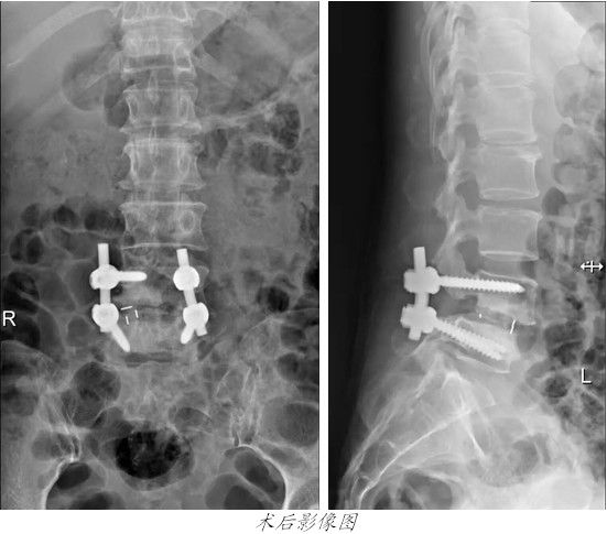 康美醫院開展微創手術治療腰椎滑脫
